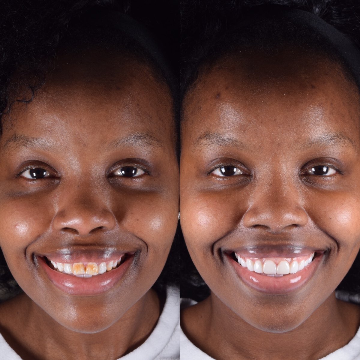 8 Composite Veneers before and after — patient of Dr Bikram Narang, cosmetic dentist in Maidenhead