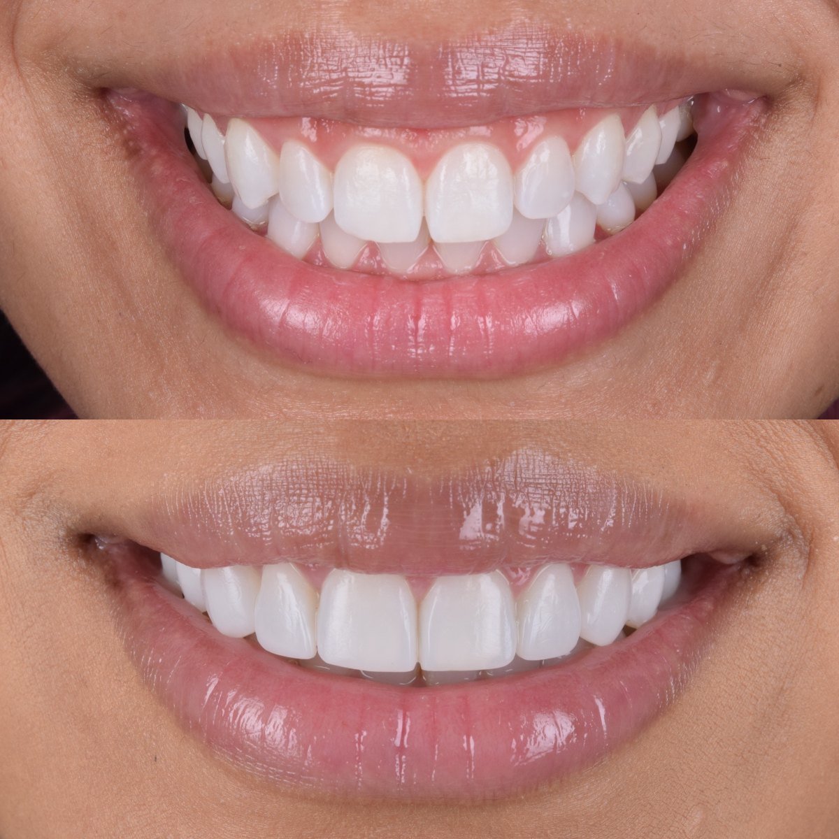 6 Composite Veneers Following Invisalign before and after — patient of Dr Bikram Narang, cosmetic dentist in Maidenhead